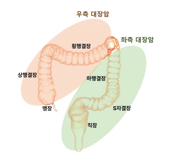 정면에서 바라본 대장암의 위치별 분류[병원 제공]